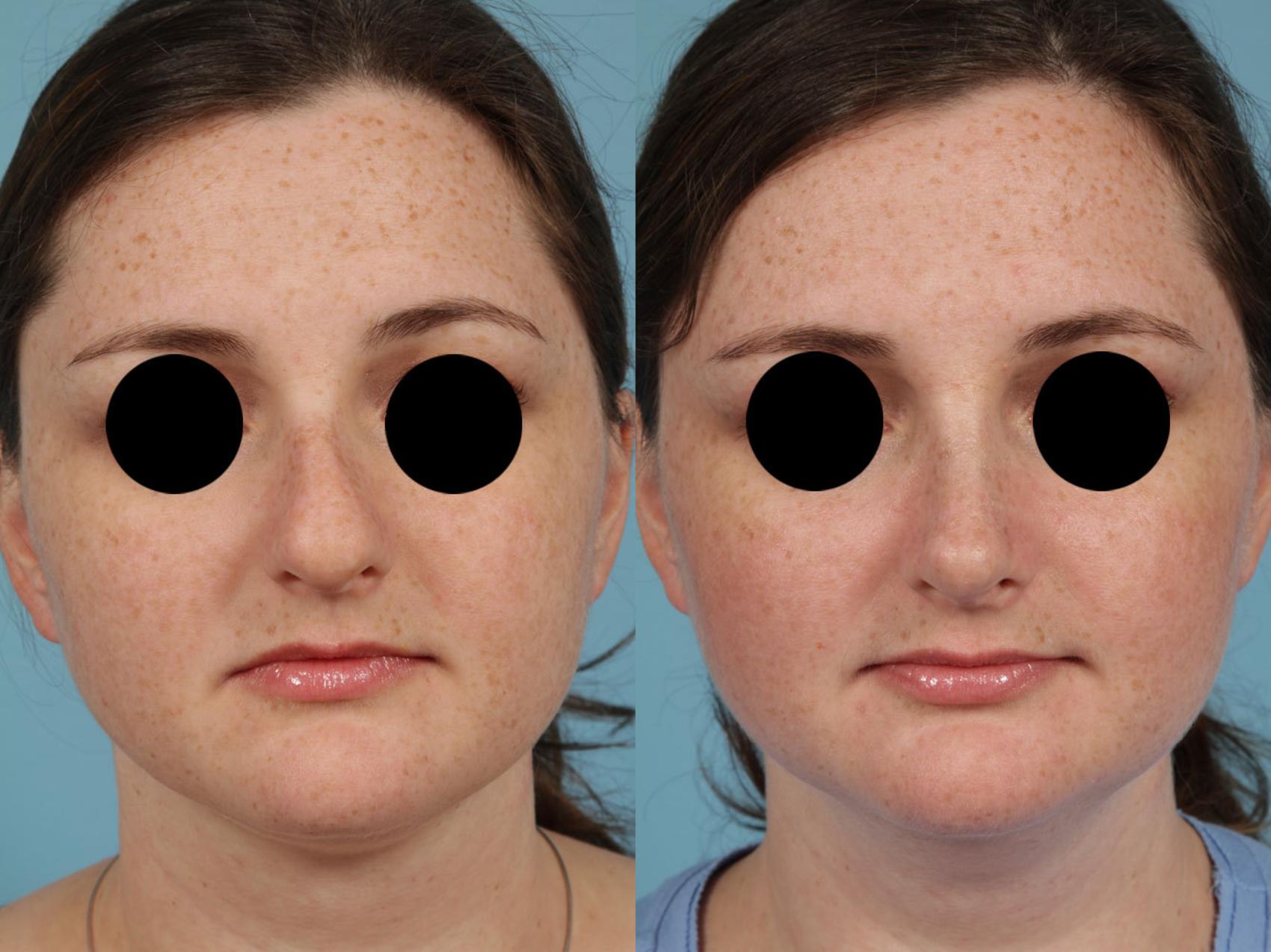Before & After Rhinoplasty by Dr. Mustoe Case 246 View #8 View in Chicago, IL