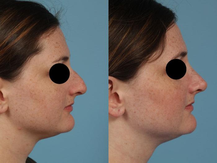 Before & After Rhinoplasty by Dr. Mustoe Case 246 View #9 View in Chicago, IL