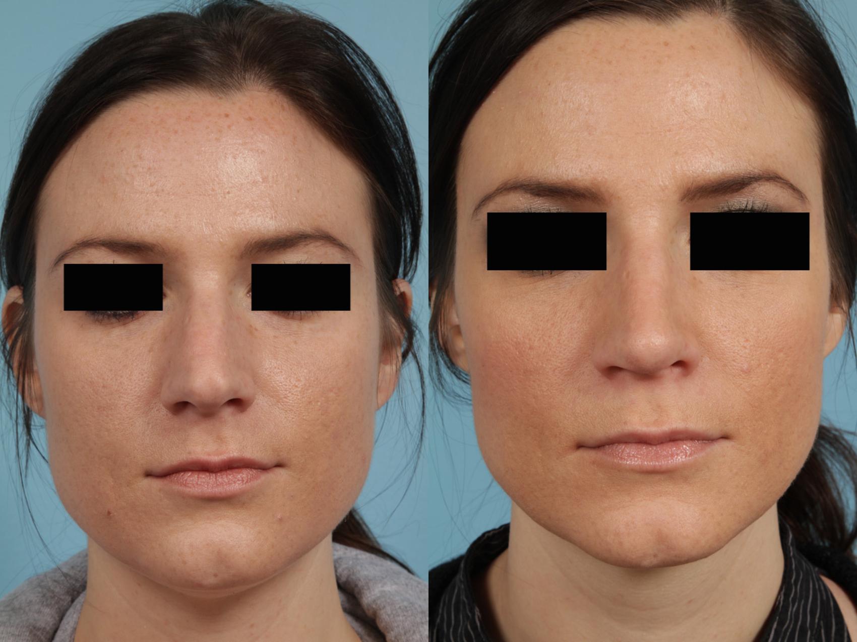 Before & After Rhinoplasty by Dr. Mustoe Case 267 View #4 View in Chicago, IL