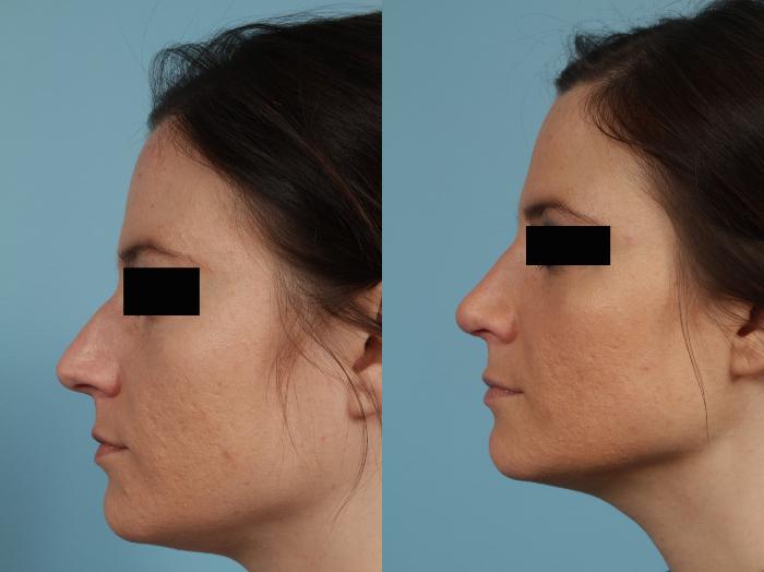 Before & After Rhinoplasty by Dr. Mustoe Case 267 View #5 View in Chicago, IL