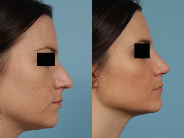 Before & After Rhinoplasty by Dr. Mustoe Case 267 View #6 View in Chicago, IL