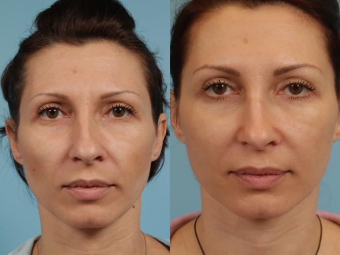 Before & After Rhinoplasty by Dr. Mustoe Case 289 View #3 View in Chicago, IL
