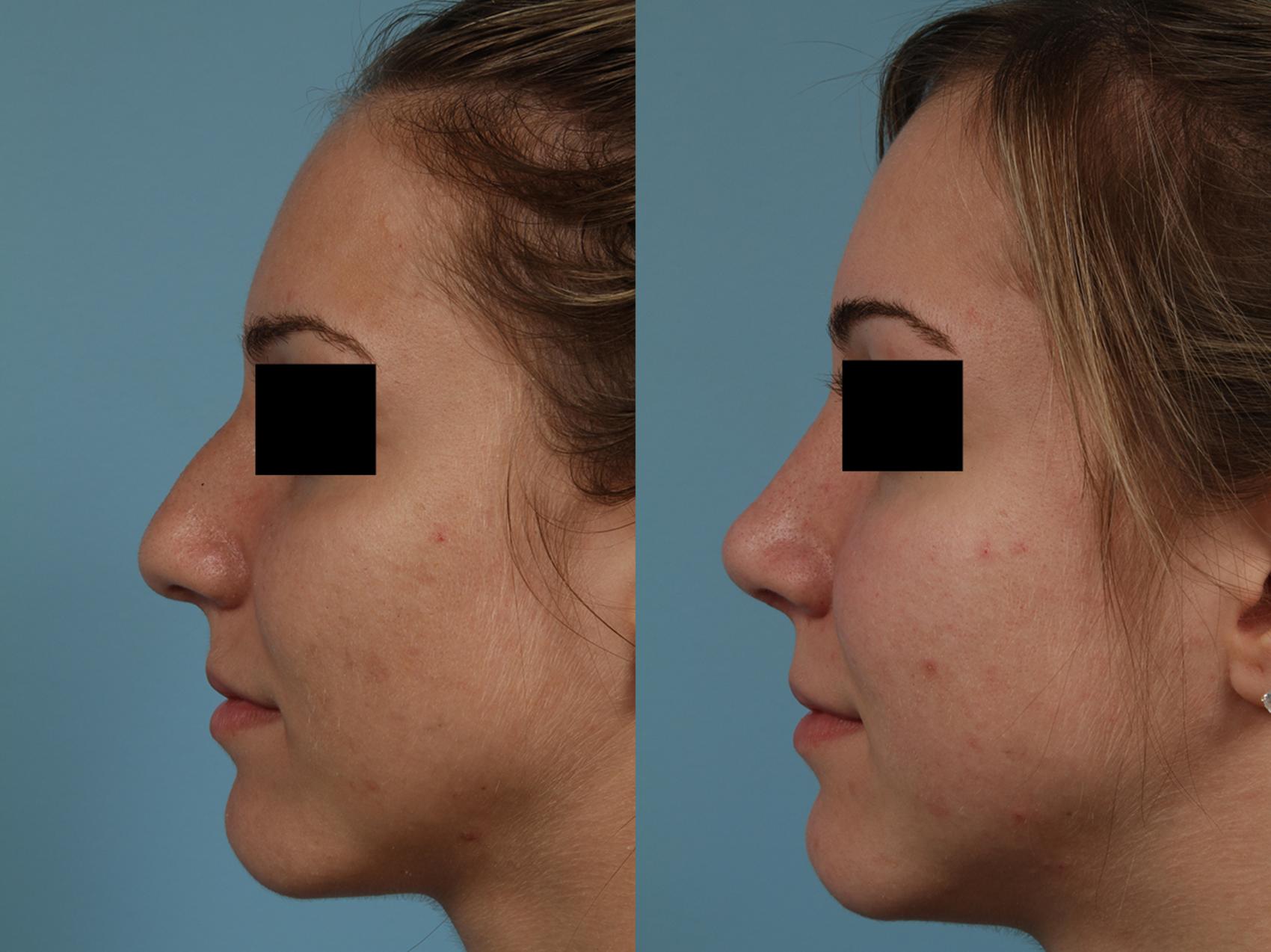 Before & After Rhinoplasty by Dr. Mustoe Case 324 View #1 View in Chicago, IL