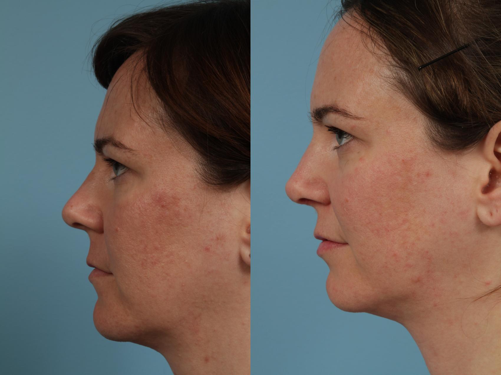 Before & After Rhinoplasty by Dr. Mustoe Case 327 View #1 View in Chicago, IL