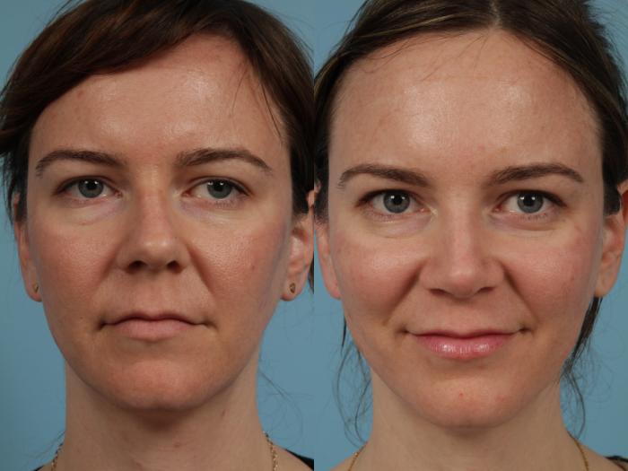 Before & After Rhinoplasty by Dr. Mustoe Case 327 View #2 View in Chicago, IL