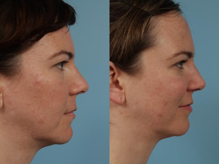 Before & After Rhinoplasty by Dr. Mustoe Case 327 View #3 View in Chicago, IL