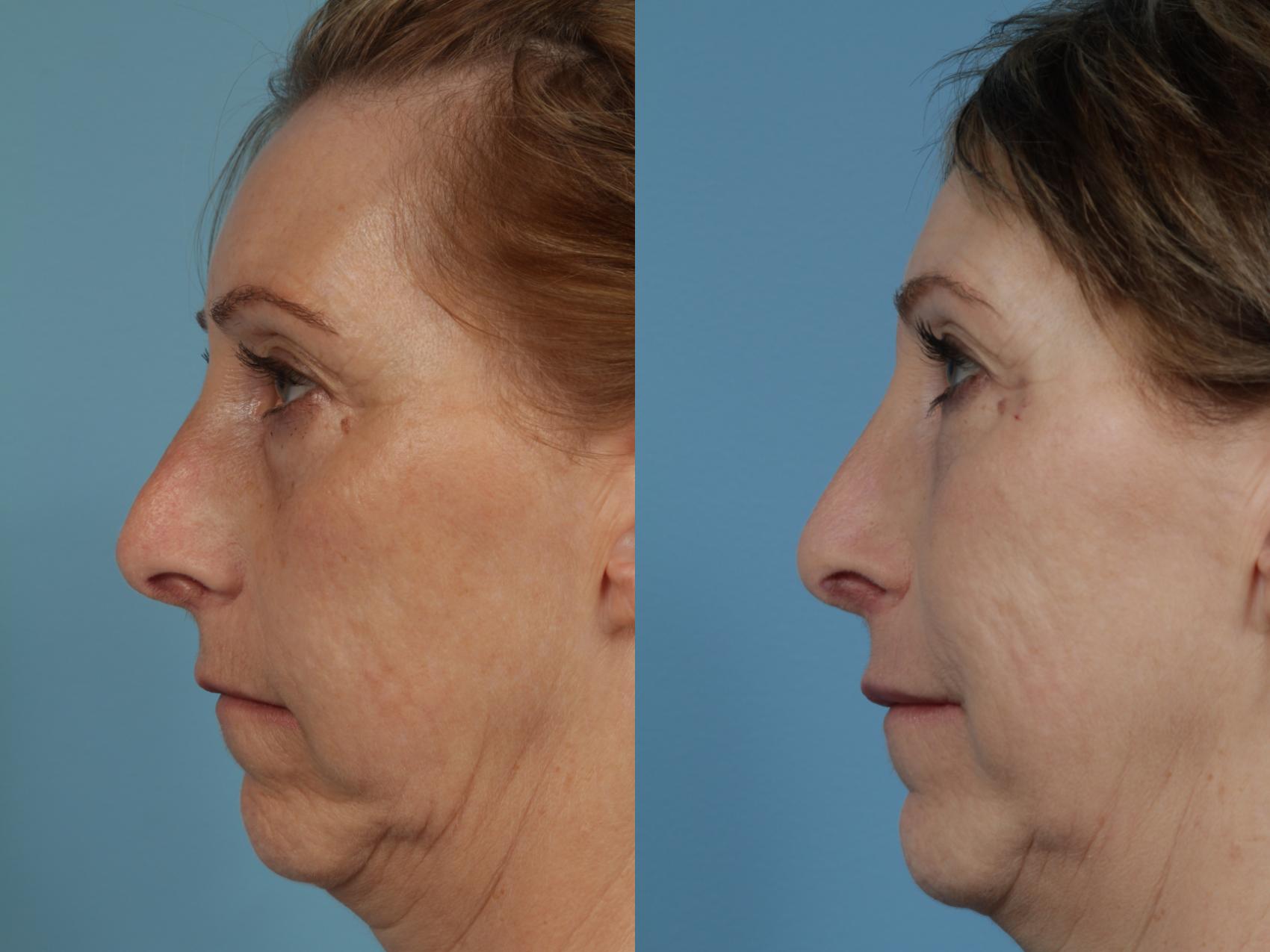 Before & After Rhinoplasty by Dr. Mustoe Case 351 View #1 View in Chicago, IL