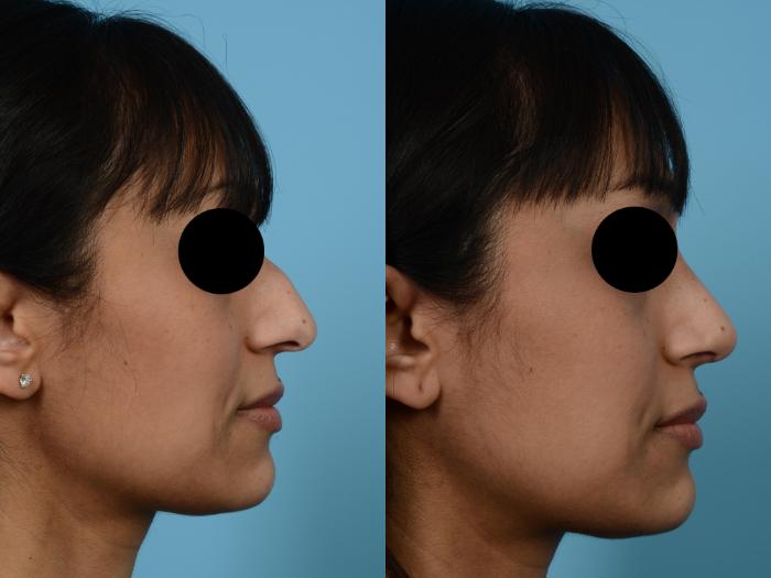 Before & After Rhinoplasty by Dr. Mustoe Case 463 View #2 View in Chicago, IL