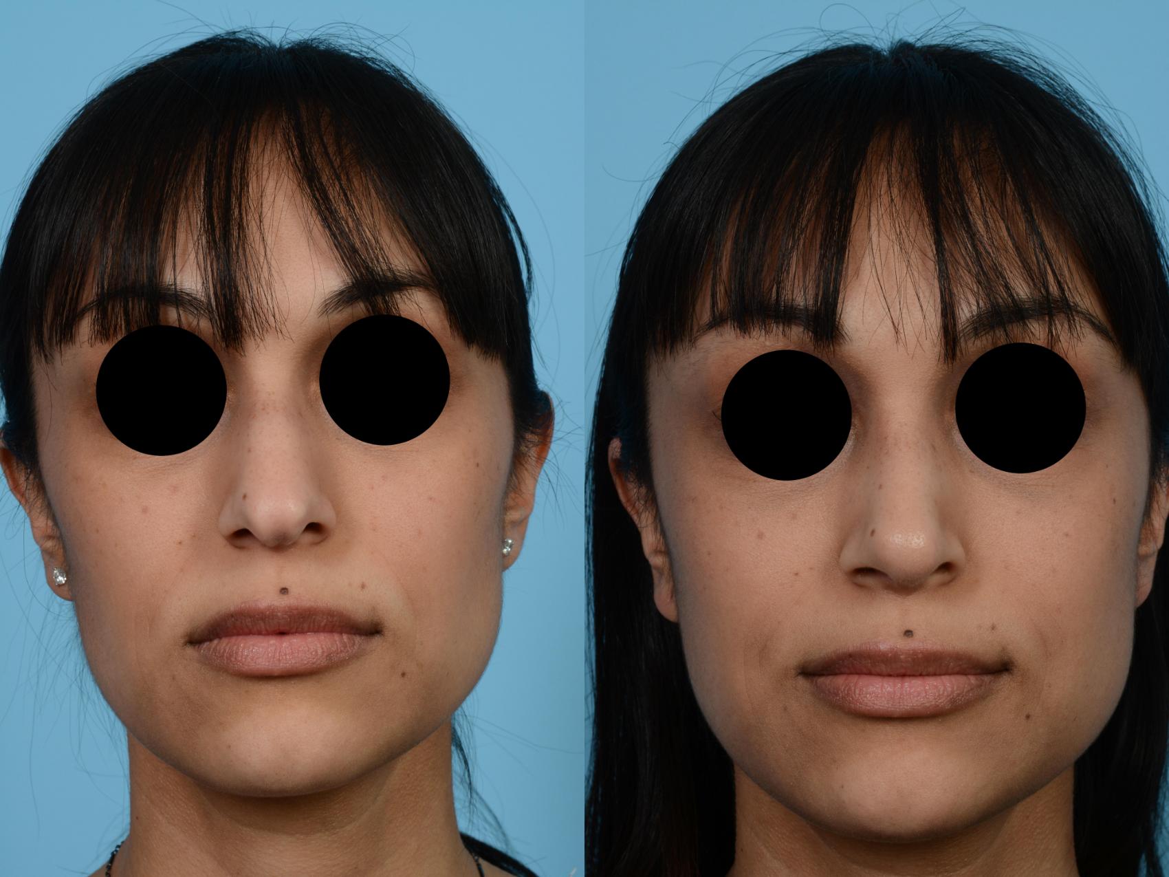 Before & After Rhinoplasty by Dr. Mustoe Case 463 View #3 View in Chicago, IL