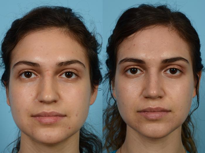Before & After Rhinoplasty by Dr. Mustoe Case 496 View #2 View in Chicago, IL