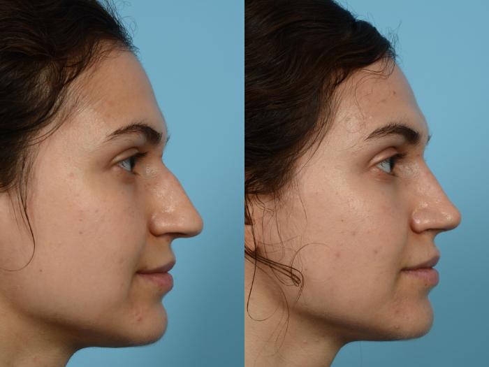 Before & After Rhinoplasty by Dr. Mustoe Case 496 View #3 View in Chicago, IL