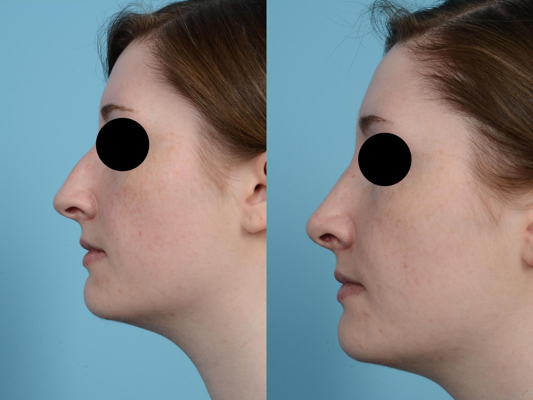 Before & After Rhinoplasty by Dr. Mustoe Case 506 View #1 View in Chicago, IL