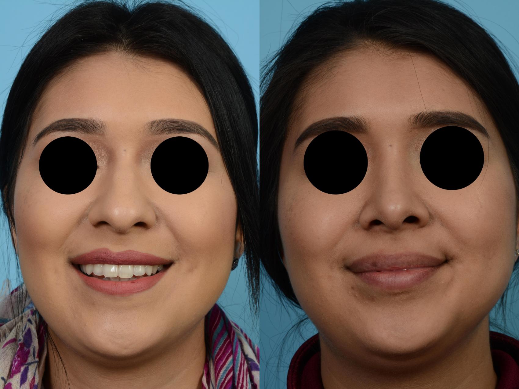 Before & After Rhinoplasty by Dr. Mustoe Case 508 View #1 View in Chicago, IL