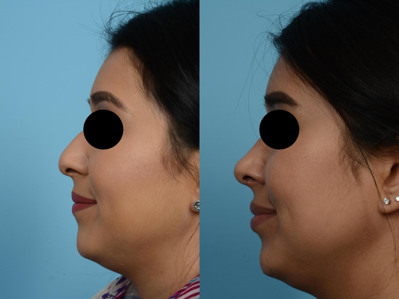 Before & After Rhinoplasty by Dr. Mustoe Case 508 View #2 View in Chicago, IL