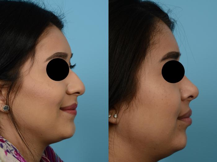 Before & After Rhinoplasty by Dr. Mustoe Case 508 View #3 View in Chicago, IL