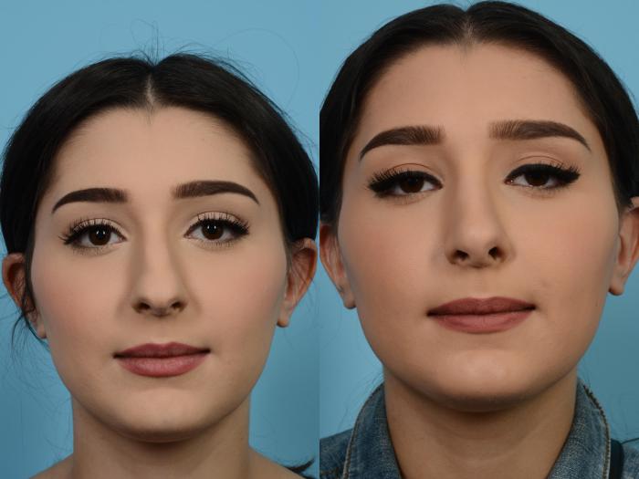 Before & After Rhinoplasty by Dr. Mustoe Case 526 View #2 View in Chicago, IL