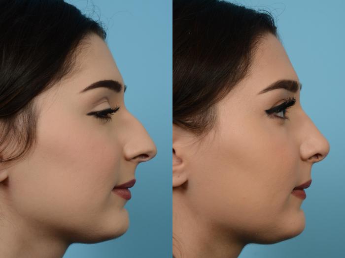 Before & After Rhinoplasty by Dr. Mustoe Case 526 View #3 View in Chicago, IL