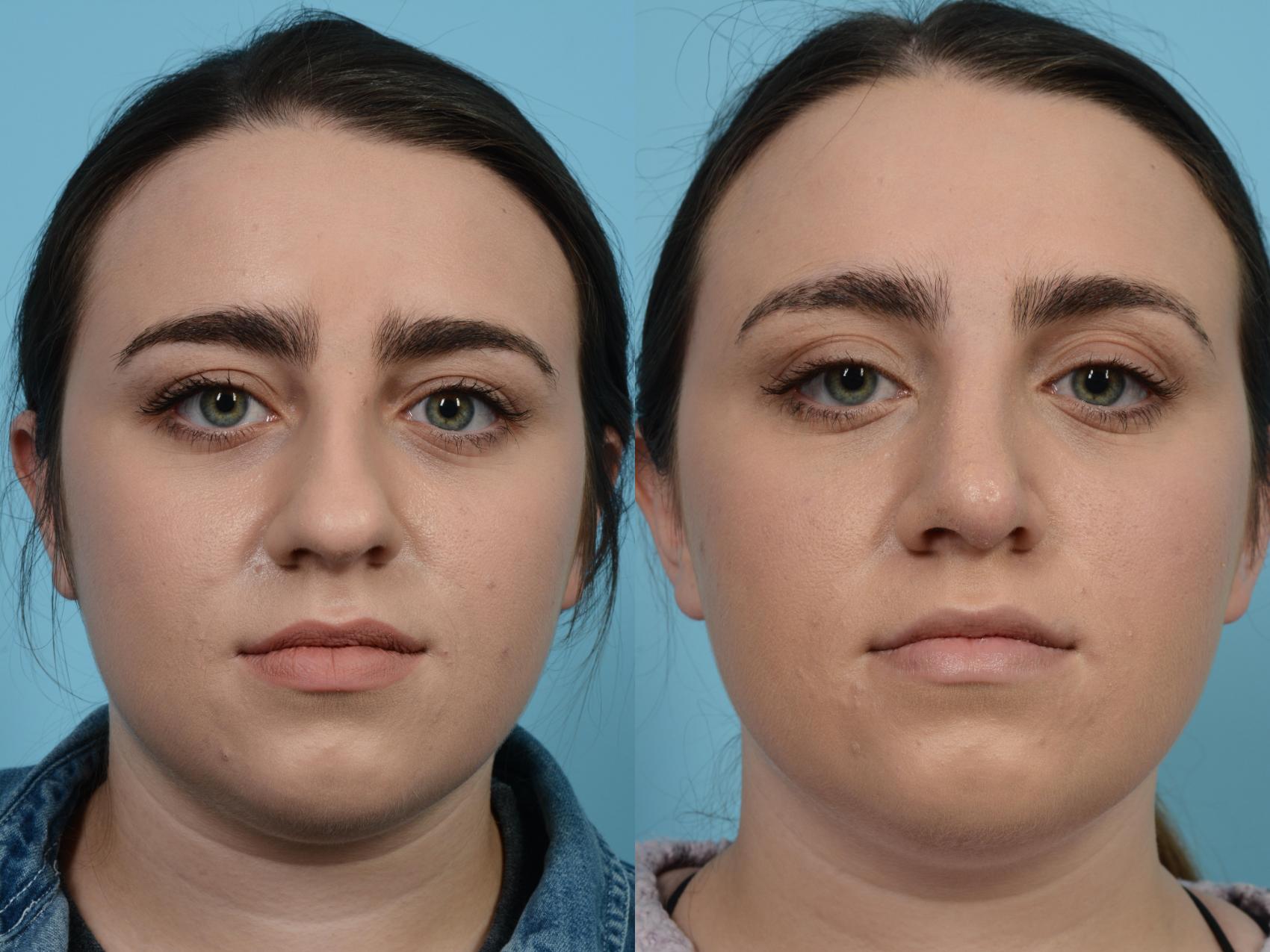 Before & After Rhinoplasty by Dr. Mustoe Case 577 View #1 View in Chicago, IL