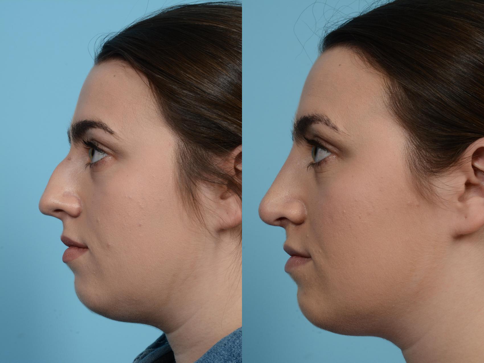 Before & After Rhinoplasty by Dr. Mustoe Case 577 View #2 View in Chicago, IL