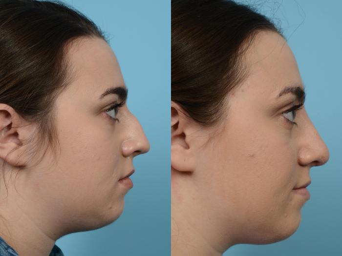 Before & After Rhinoplasty by Dr. Mustoe Case 577 View #3 View in Chicago, IL