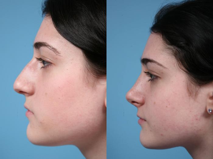 Before & After Rhinoplasty by Dr. Mustoe Case 58 View #1 View in Chicago, IL