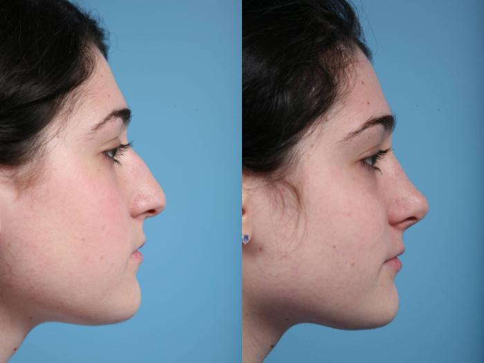 Before & After Rhinoplasty by Dr. Mustoe Case 58 View #2 View in Chicago, IL