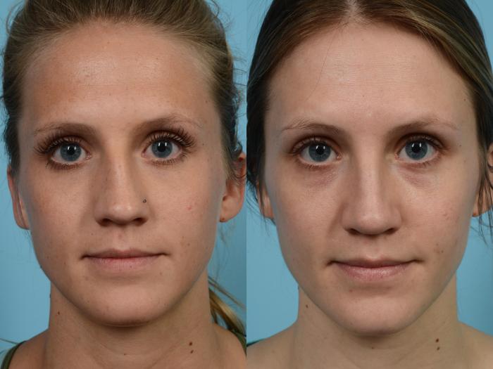 Before & After Rhinoplasty by Dr. Mustoe Case 580 View #1 View in Chicago, IL