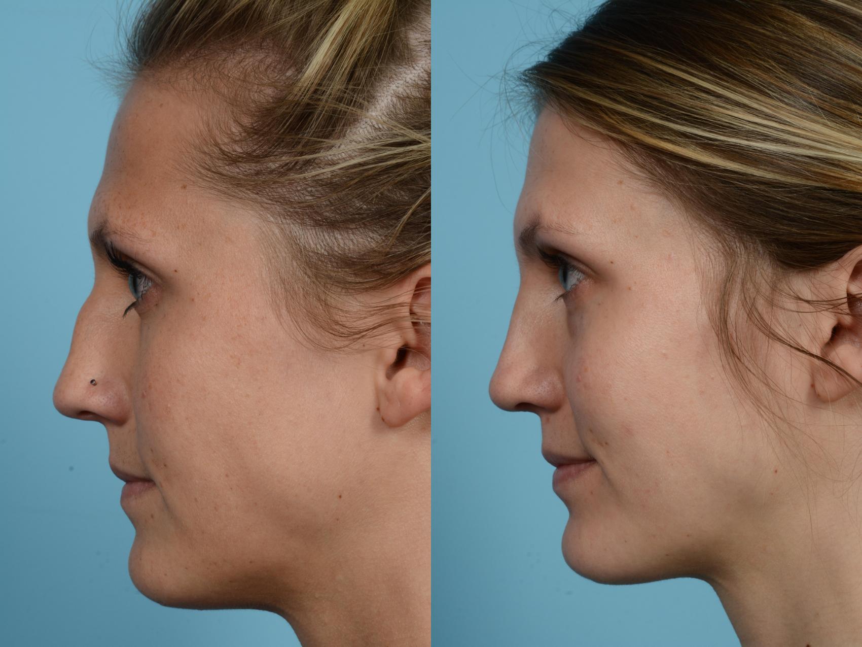 Before & After Rhinoplasty by Dr. Mustoe Case 580 View #2 View in Chicago, IL