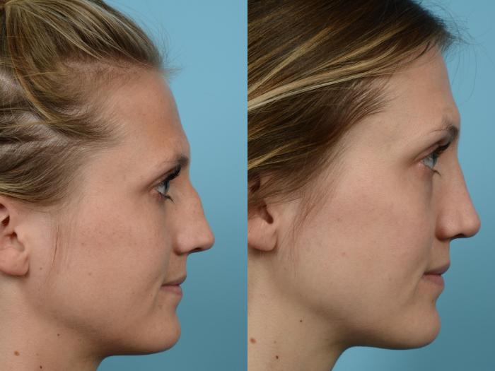 Before & After Rhinoplasty by Dr. Mustoe Case 580 View #3 View in Chicago, IL