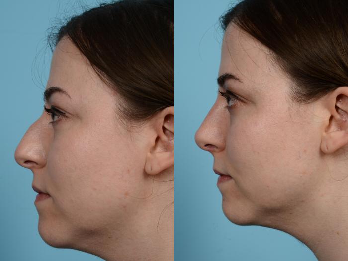 Before & After Rhinoplasty by Dr. Mustoe Case 584 View #1 View in Chicago, IL
