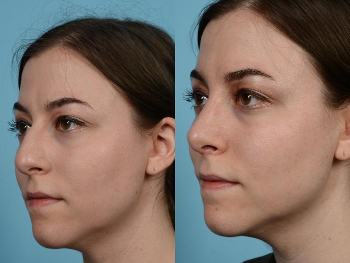 Before & After Rhinoplasty by Dr. Mustoe Case 584 View #2 View in Chicago, IL