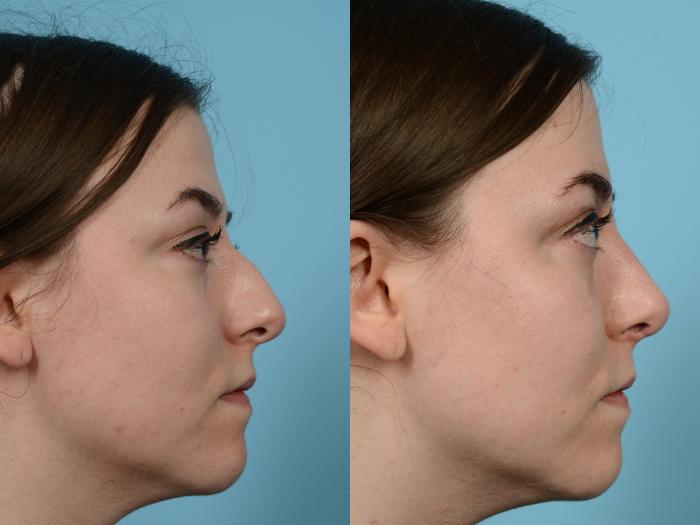 Before & After Rhinoplasty by Dr. Mustoe Case 584 View #3 View in Chicago, IL