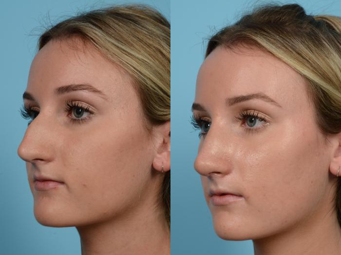 Before & After Rhinoplasty by Dr. Mustoe Case 585 View #2 View in Chicago, IL