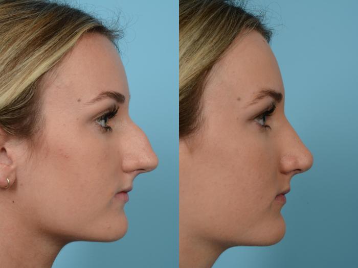 Before & After Rhinoplasty by Dr. Mustoe Case 585 View #3 View in Chicago, IL