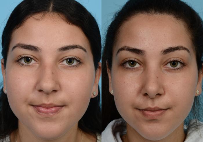 Before & After Rhinoplasty by Dr. Mustoe Case 586 Front View in Chicago, IL