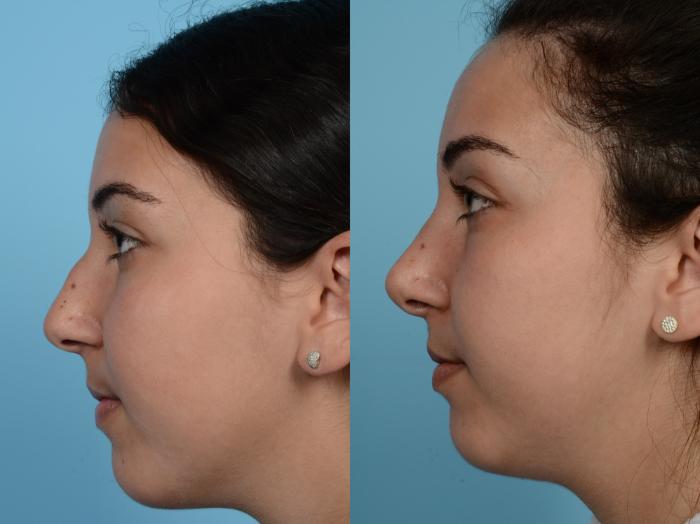 Before & After Rhinoplasty by Dr. Mustoe Case 586 Left Side View in Chicago, IL