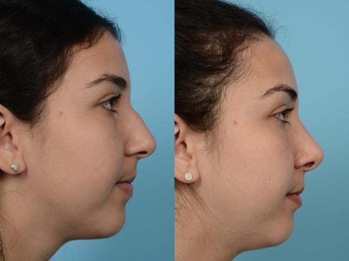 Before & After Rhinoplasty by Dr. Mustoe Case 586 Right Side View in Chicago, IL