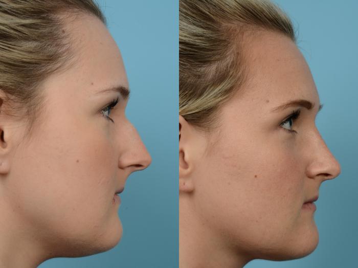 Before & After Rhinoplasty by Dr. Mustoe Case 588 Right Side View in Chicago, IL