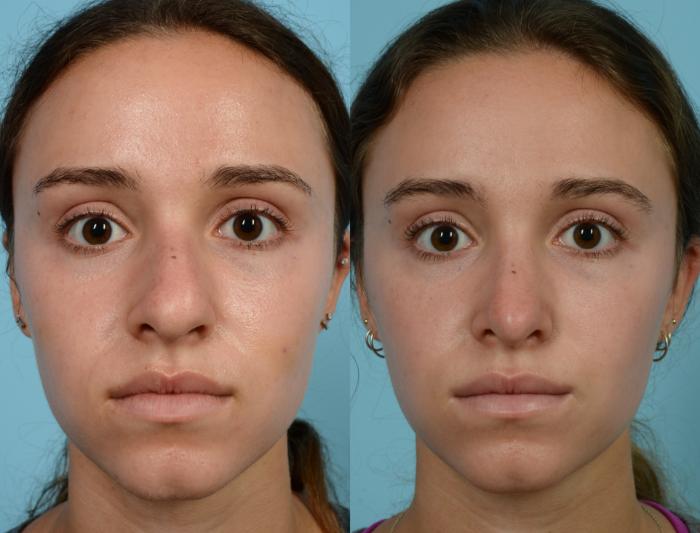 Dr. Thomas Mustoe in Chicago performed Rhinoplasty surgery on this female 18-24 years old.