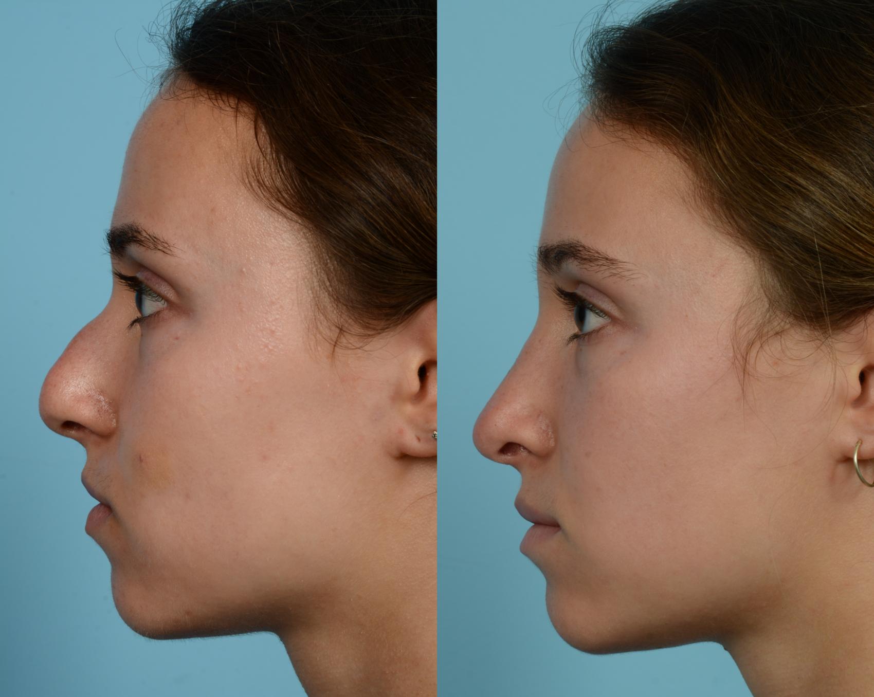 Dr. Mustoe in Chicago performed Rhinoplasty on a female age 18-24 years of age.