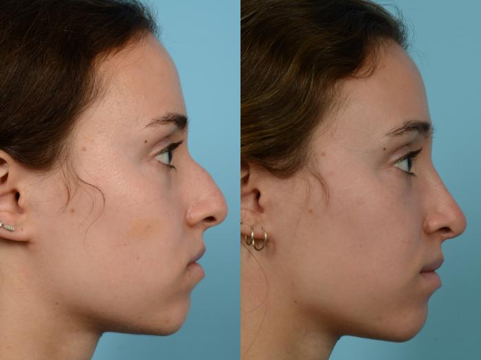 Before & After Rhinoplasty by Dr. Mustoe Case 608 Right Side View in Chicago, IL