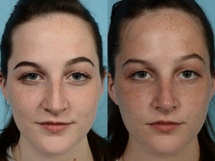 Before & After Rhinoplasty by Dr. Mustoe Case 626 Front View in Chicago, IL