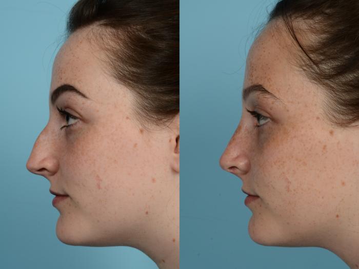 Before & After Rhinoplasty by Dr. Mustoe Case 626 Left Side View in Chicago, IL