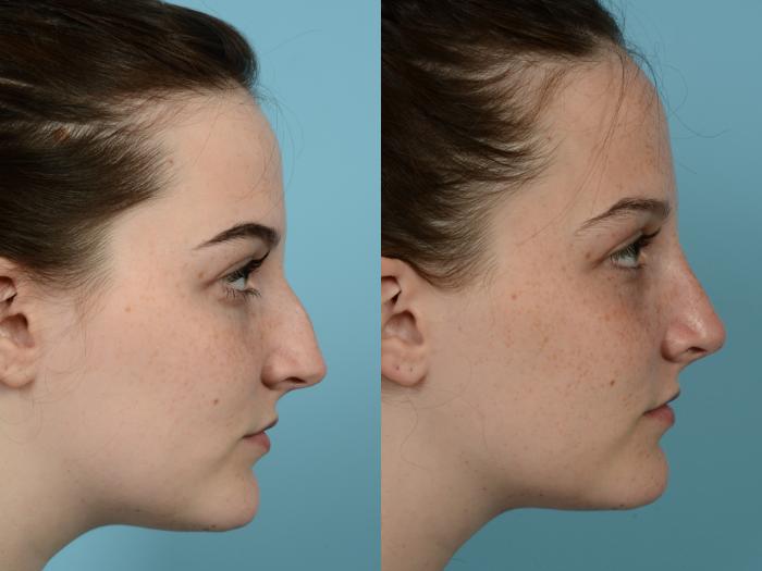 Before & After Rhinoplasty by Dr. Mustoe Case 626 Right Side View in Chicago, IL