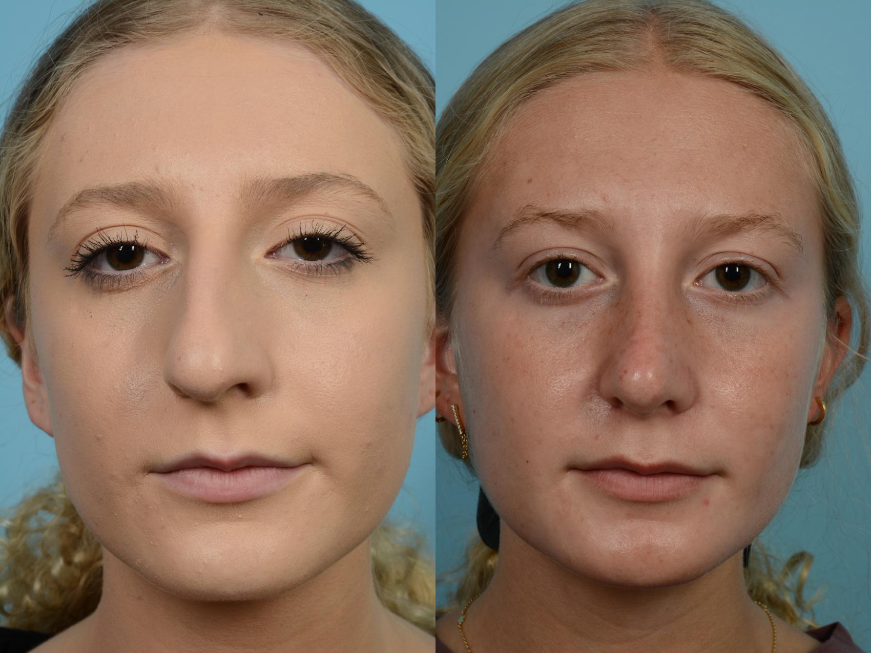 Before & After Rhinoplasty by Dr. Mustoe Case 627 Front View in Chicago, IL