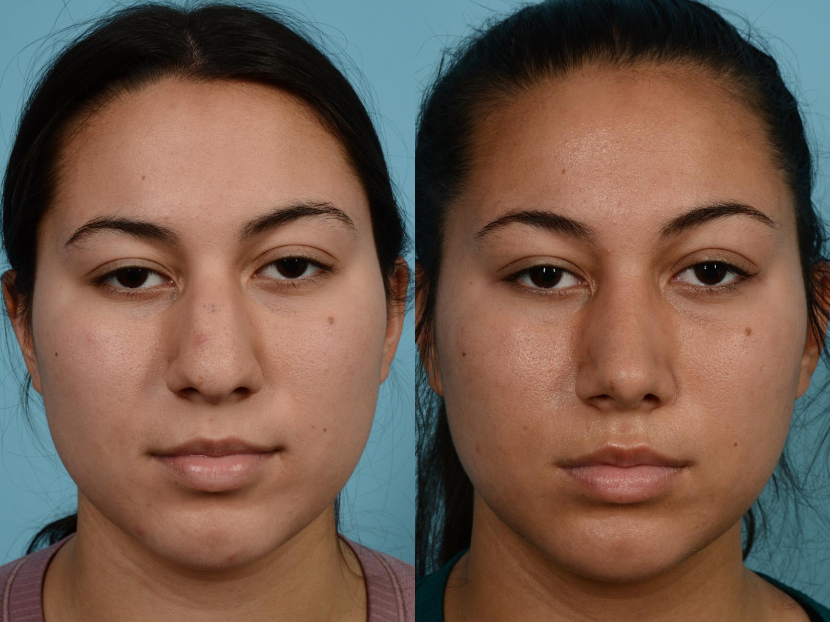 Before & After Rhinoplasty by Dr. Mustoe Case 628 Front View in Chicago, IL