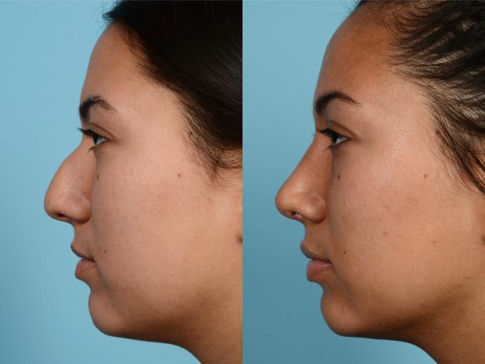 Before & After Rhinoplasty by Dr. Mustoe Case 628 Left Side View in Chicago, IL