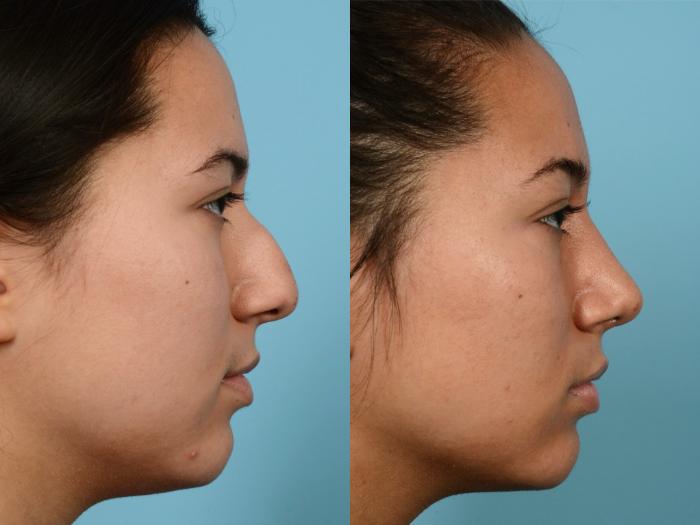 Before & After Rhinoplasty by Dr. Mustoe Case 628 Right Side View in Chicago, IL