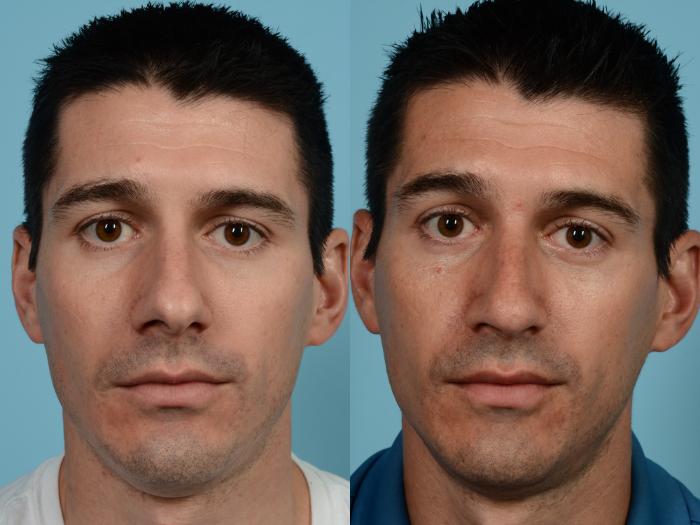 Before & After Rhinoplasty by Dr. Mustoe Case 672 Front View in Chicago, IL