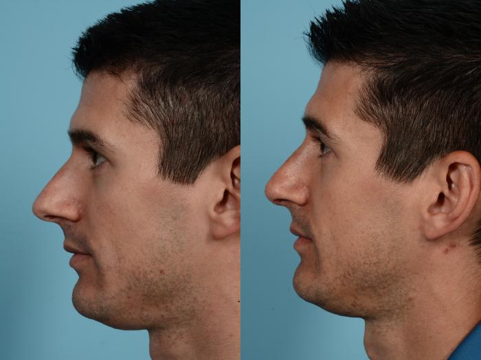 Before & After Rhinoplasty by Dr. Mustoe Case 672 Left Side View in Chicago, IL